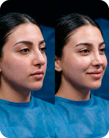 Antes e depois rinoplastia - Caso 1