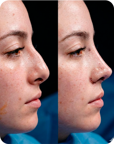 Antes e depois rinoplastia - Caso 3